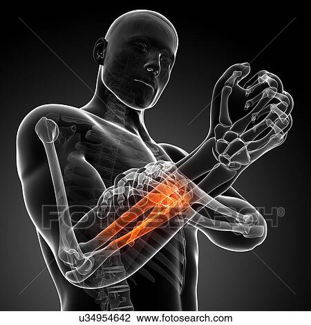 Human arm pain, artwork View Large Illustration Drawing - Human arm pain, artwork. Fotosearch