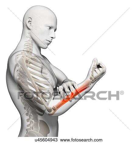 Human arm pain, artwork View Large Illustration Drawing - Human arm pain, artwork. Fotosearch