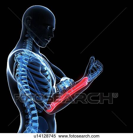 Stock Illustration - Human arm pain, artwork. Fotosearch