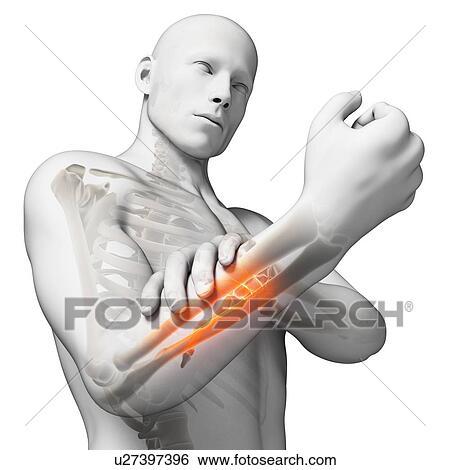 Human arm pain, artwork View Large Illustration Stock Illustration - Human arm pain, artwork. Fotosearch