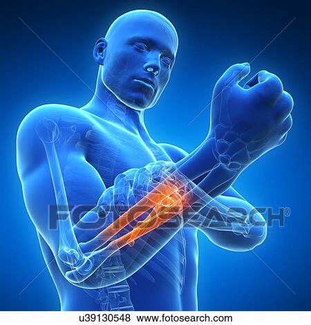 Human arm pain, artwork View Large Illustration Stock Illustration - Human arm pain, artwork. Fotosearch