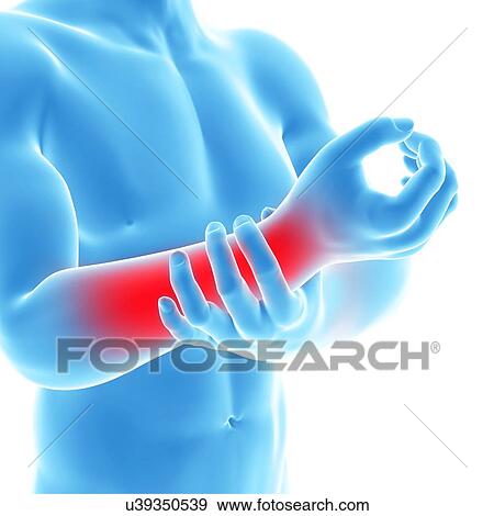 Human arm pain, artwork View Large Illustration Stock Illustration - Human arm pain, artwork. Fotosearch