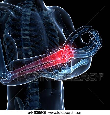 Human arm pain, artwork View Large Illustration Stock Illustration - Human arm pain, artwork. Fotosearch