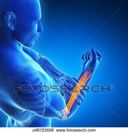 Stock Illustration - Human arm pain, artwork. Fotosearch