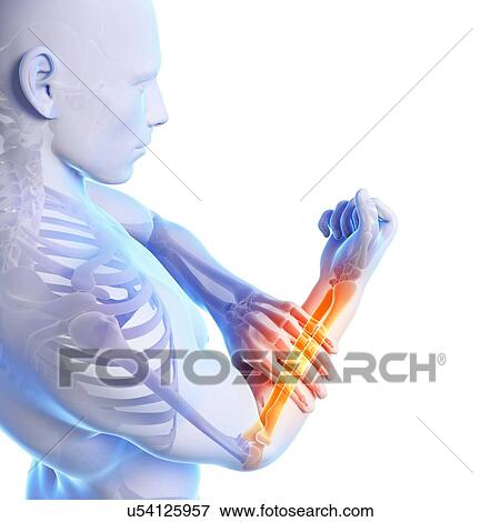 Stock Illustration - Human arm pain, artwork. Fotosearch