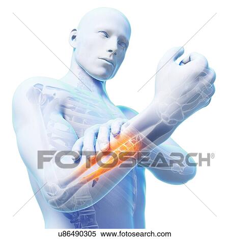 Stock Illustration - Human arm pain, artwork. Fotosearch