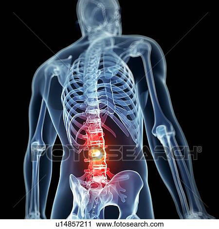 Human back pain, artwork View Large Illustration Clip Art - Human back pain, artwork. Fotosearch