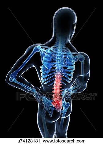Clip Art - Human back pain, artwork. Fotosearch