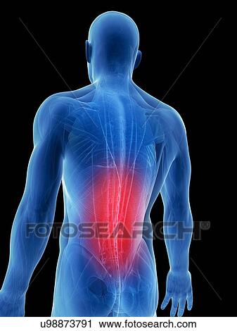 Clip Art - Human back pain, artwork. Fotosearch