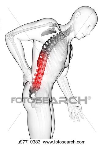Drawing - Human back pain, artwork. Fotosearch