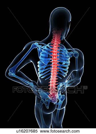 Stock Illustration - Human back pain, artwork. Fotosearch