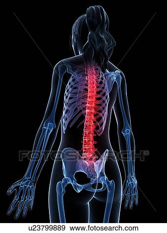 Stock Illustration - Human back pain, artwork. Fotosearch