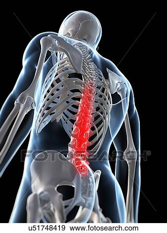 Stock Illustration - Human back pain, artwork. Fotosearch