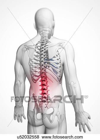 Stock Illustration - Human back pain, artwork. Fotosearch