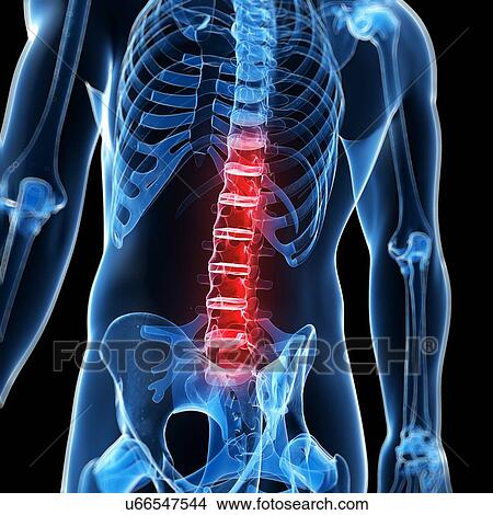 Stock Illustration - Human back pain, artwork. Fotosearch