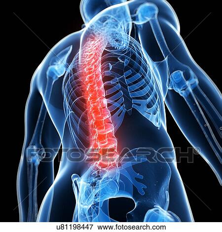 Stock Illustration - Human back pain, artwork. Fotosearch