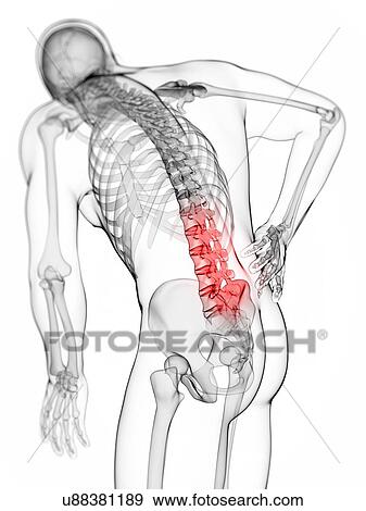 Stock Illustration - Human back pain, artwork. Fotosearch