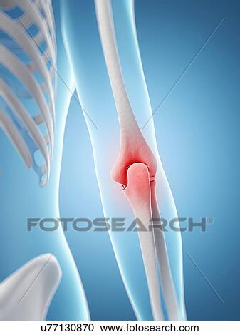 Clipart - Human elbow pain, artwork. Fotosearch