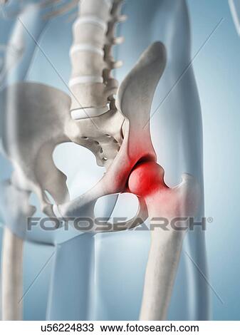Human hip pain, artwork View Large Illustration Drawing - Human hip pain, artwork. Fotosearch