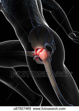 Stock Illustration - Human hip pain, artwork. Fotosearch