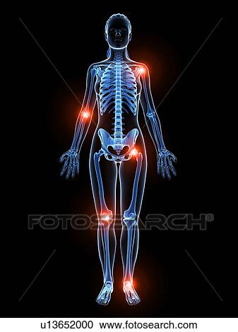 Human joint pain, artwork View Large Illustration Clipart - Human joint pain, artwork. Fotosearch