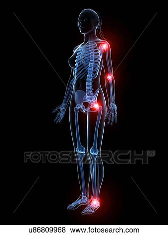 Stock Illustration - Human joint pain, artwork. Fotosearch
