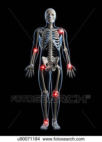 Stock Illustration - Human joint pain, artwork. Fotosearch