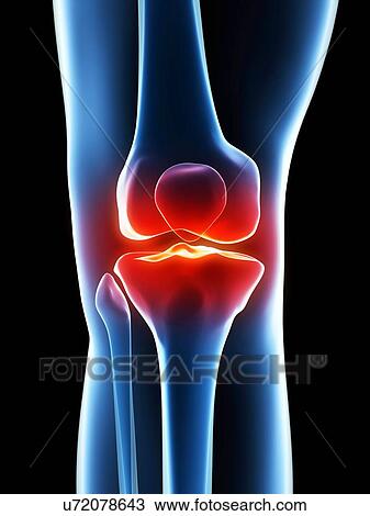 Human knee pain, artwork View Large Illustration Drawing - Human knee pain, artwork. Fotosearch