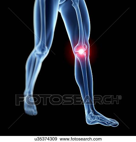 Stock Illustration - Human knee pain, artwork. Fotosearch
