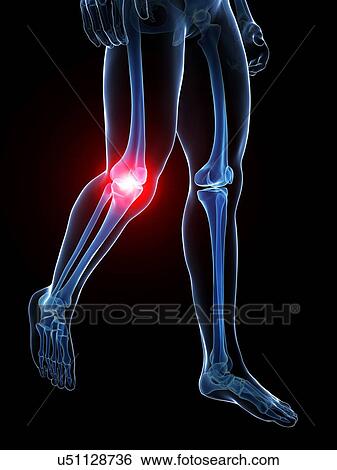 Human knee pain, artwork View Large Illustration Stock Illustration - Human knee pain, artwork. Fotosearch