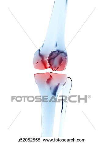 Human knee pain, artwork View Large Illustration Stock Illustration - Human knee pain, artwork. Fotosearch