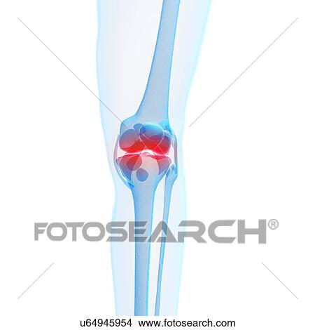 Stock Illustration - Human knee pain, artwork. Fotosearch