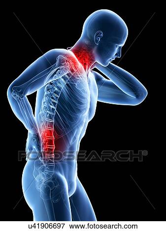 Human neck and back pain, artwork View Large Illustration Stock Illustration - Human neck and back pain, artwork. Fotosearch