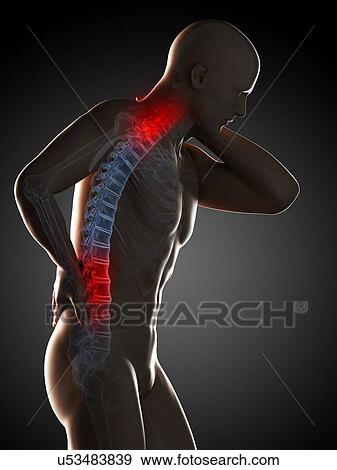 Stock Illustration - Human neck and back pain, artwork. Fotosearch