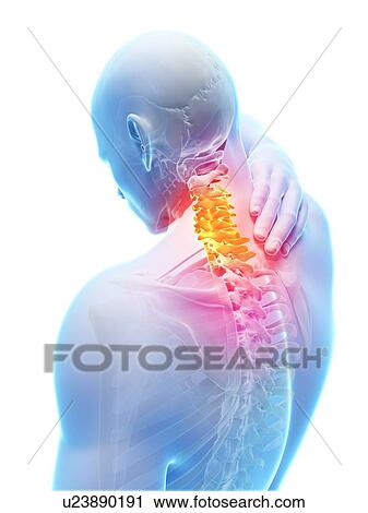 Human neck pain, artwork View Large Illustration Clip Art - Human neck pain, artwork. Fotosearch