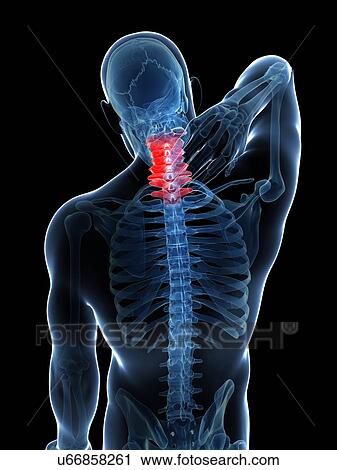 Human neck pain, artwork View Large Illustration Clip Art - Human neck pain, artwork. Fotosearch