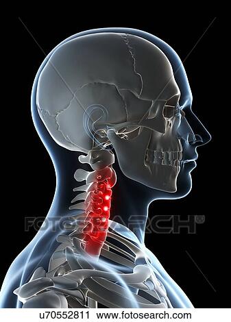 Human neck pain, artwork View Large Illustration Clip Art - Human neck pain, artwork. Fotosearch