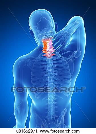 Clip Art - Human neck pain, artwork. Fotosearch