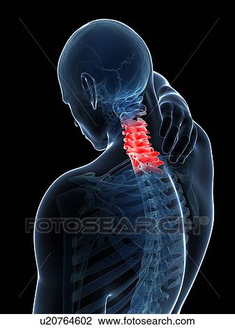 Drawing - Human neck pain, artwork. Fotosearch