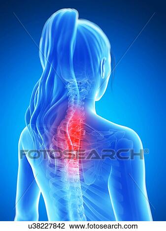 Drawing - Human neck pain, artwork. Fotosearch