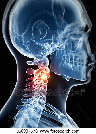 Human neck pain, artwork View Large Illustration Drawing - Human neck pain, artwork. Fotosearch