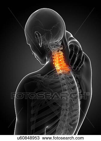 Human neck pain, artwork View Large Illustration Drawing - Human neck pain, artwork. Fotosearch