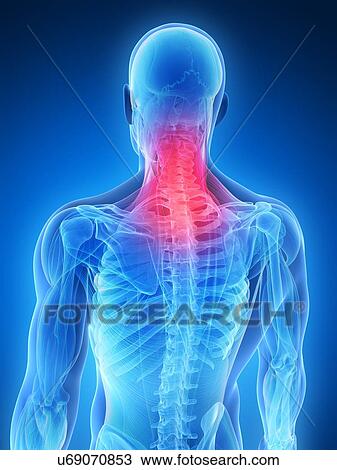 Drawing - Human neck pain, artwork. Fotosearch