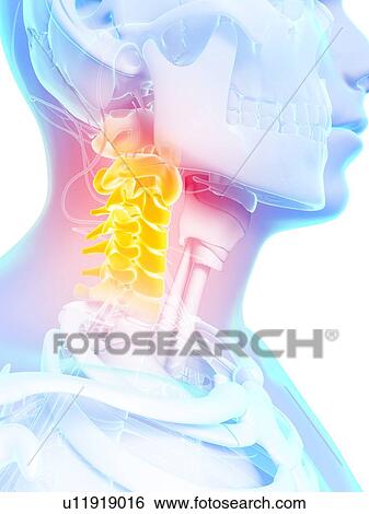 Human neck pain, artwork View Large Illustration Stock Illustration - Human neck pain, artwork. Fotosearch