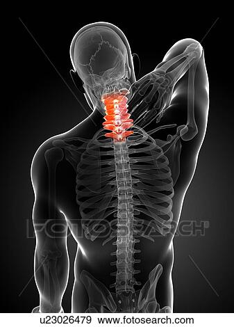 Human neck pain, artwork View Large Illustration Stock Illustration - Human neck pain, artwork. Fotosearch