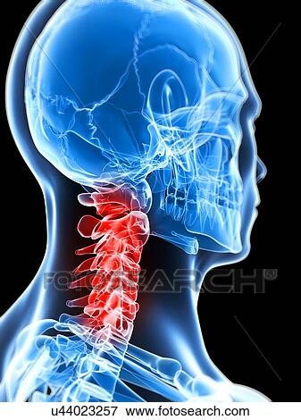 Stock Illustration - Human neck pain, artwork. Fotosearch