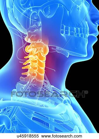 Human neck pain, artwork View Large Illustration Stock Illustration - Human neck pain, artwork. Fotosearch