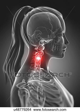 Stock Illustration - Human neck pain, artwork. Fotosearch