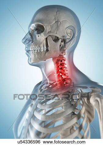 Human neck pain, artwork View Large Illustration Stock Illustration - Human neck pain, artwork. Fotosearch