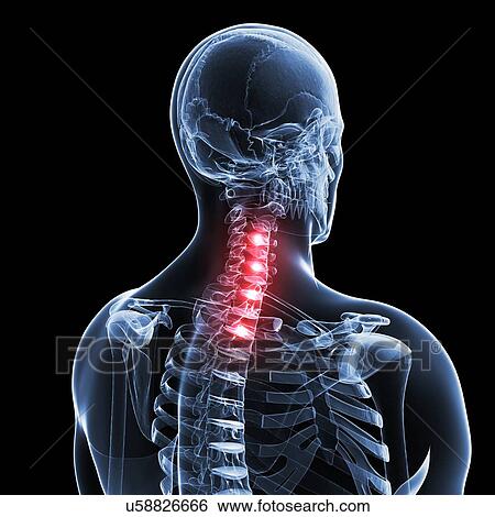 Human neck pain, artwork View Large Illustration Stock Illustration - Human neck pain, artwork. Fotosearch